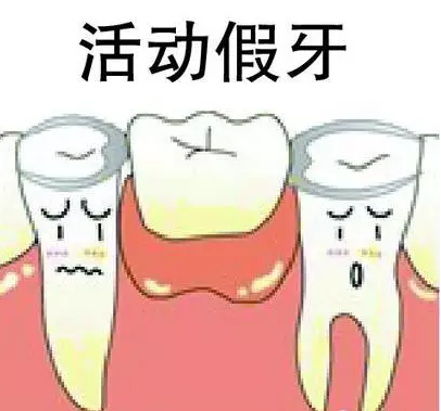 活動義(yi) 齒多少錢一顆