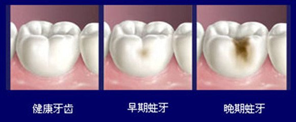 小孩牙齒長蟲