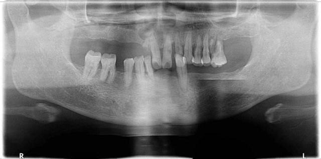 牙齦萎縮怎麽(me) 治療