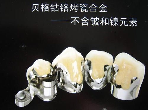 鈷鉻烤瓷牙能用多長時間