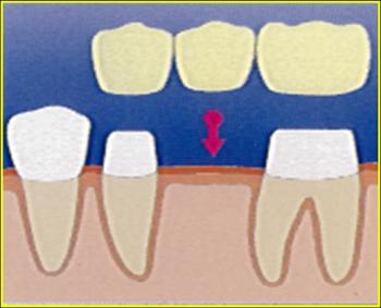鈷鉻烤瓷牙價(jia) 格