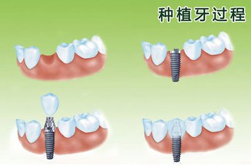 深圳種植牙多少錢一顆