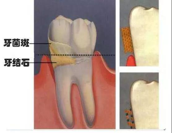牙結石洗牙多少錢