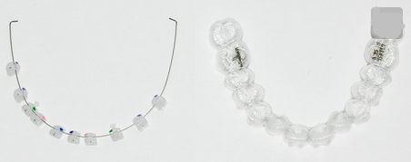  成年人還能做陶瓷牙套矯正嗎