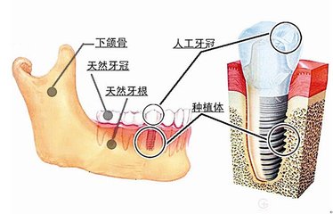 種牙和真牙的區別