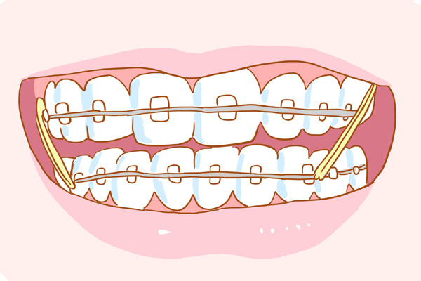 兒(er) 童矯正門牙牙齒方式