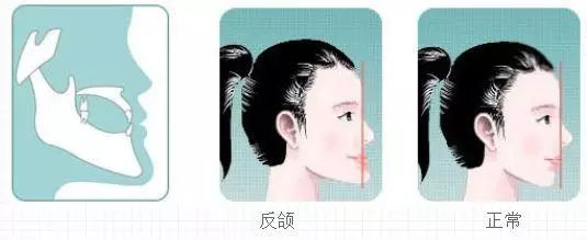 個(ge) 別牙反頜