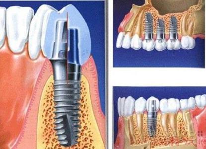 奧齒泰種植牙價(jia) 格
