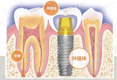 奧齒泰種植牙費用