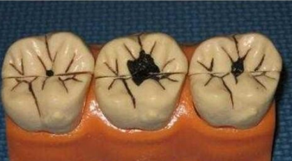 怎麽(me) 看蛀牙是否可以補牙