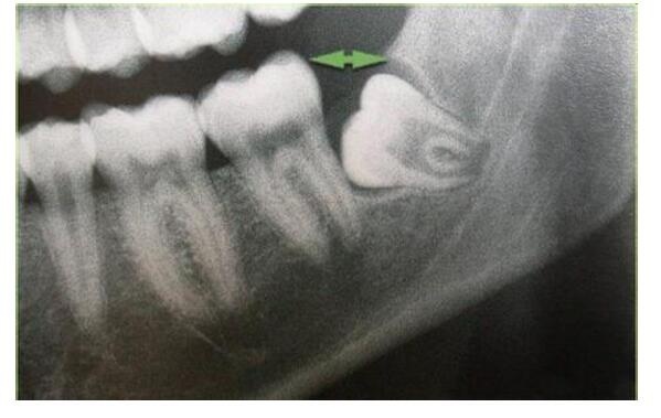 沒長出來的智齒要拔嗎