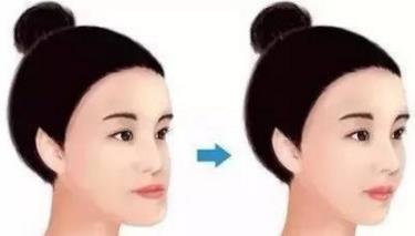 牙齒矯正需要拔牙