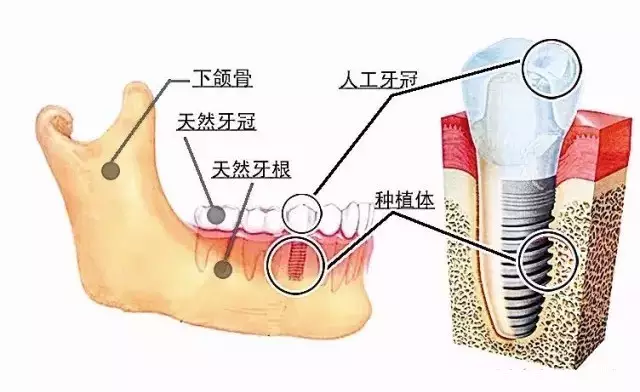 種植牙可以做核磁共振嗎