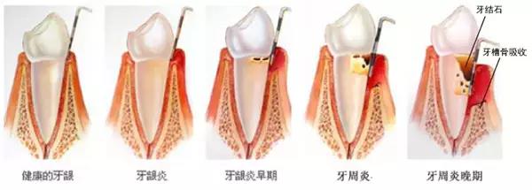 牙齦發炎