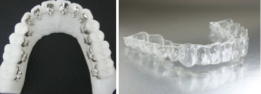 牙齒矯正牙套多少錢