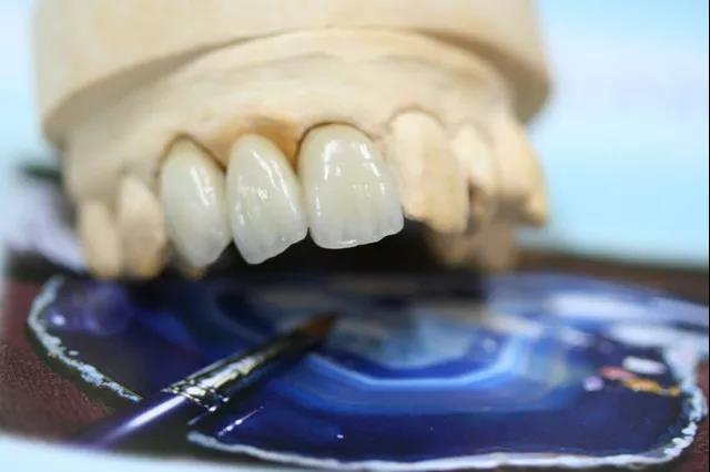 牙冠的種類及價(jia) 格