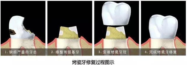 烤瓷牙的價(jia) 格