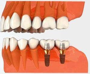 後牙種植牙價(jia) 格