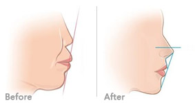齙牙需要做外科手術矯正嗎