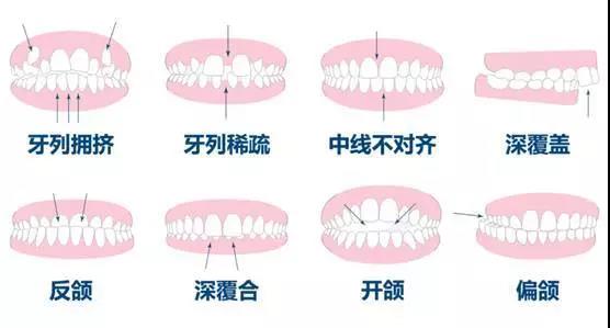 為(wei) 什麽(me) 牙齒整齊還要做矯正