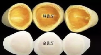 一顆全瓷牙價(jia) 格為(wei) 什麽(me) 這麽(me) 貴