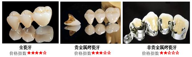 做個(ge) 烤瓷牙多少錢