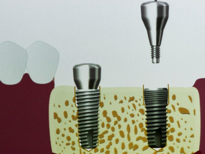 種植牙的使用壽命