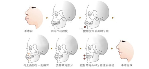 牙齒矯正正頜手術費用