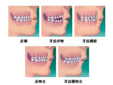 牙齒矯正的後遺症