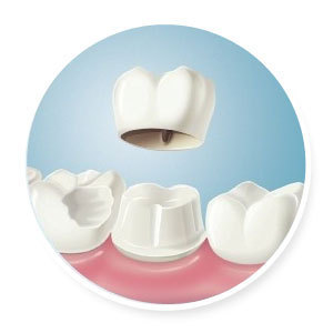 烤瓷牙牙套多少錢 