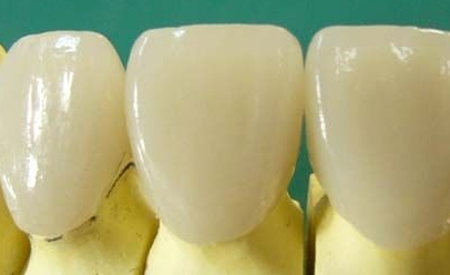 烤瓷牙牙套價(jia) 格