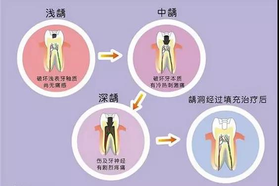 兒(er) 童乳牙齲齒要不要治療