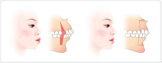 外科正牙手術費用