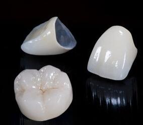 烤瓷牙一顆多少錢