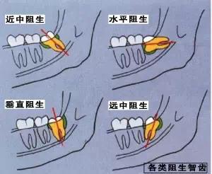 阻生牙一定要拔嗎