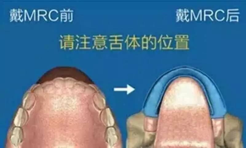 兒(er) 童牙齒反頜矯正