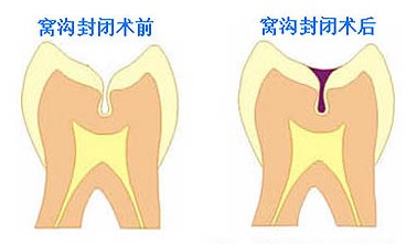 做窩溝封閉價(jia) 格