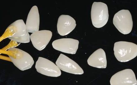 中度的氟斑牙可以變白嗎