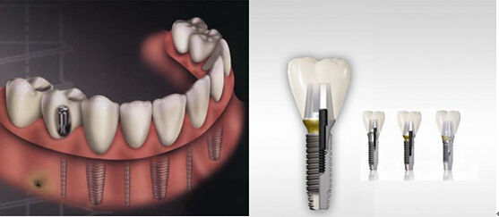 種牙過程是怎樣的