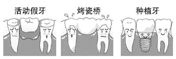 鑲牙和種牙