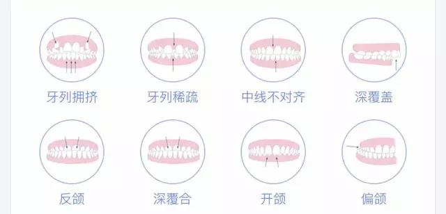 矯正牙齒費用明細