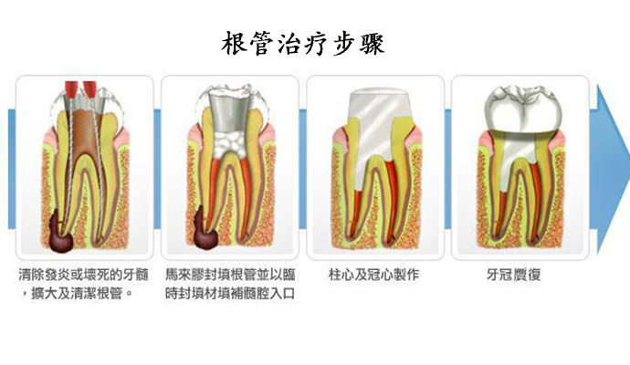 牙齒根管治療貴嗎