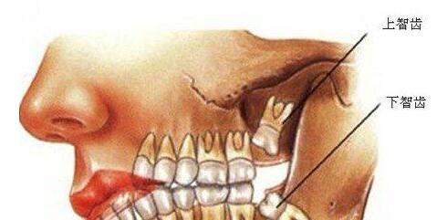 拔一個(ge) 智齒多少錢