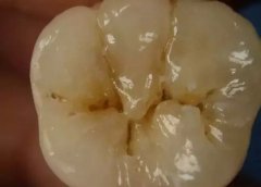 牙齒窩溝封閉價格