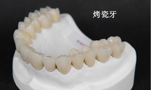 烤瓷牙修複價(jia) 格