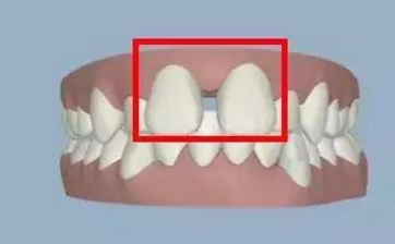 牙縫變大怎麽(me) 辦