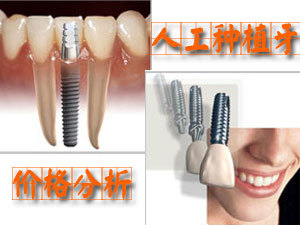 深圳種植牙多少錢