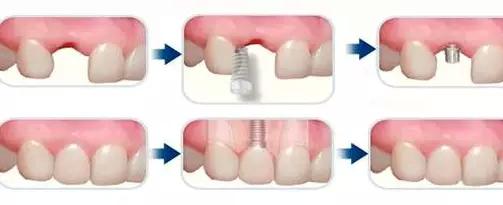 種牙有年齡限製嗎