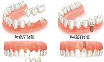 種牙和鑲牙能使用多久