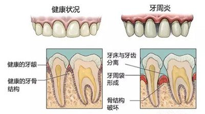 牙周治療